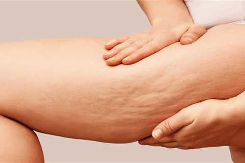 Common Myths About Cellulite