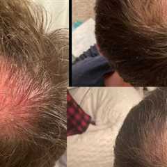 Hair Growth Injections Havertown, PA · Monday, Apr 28 📸