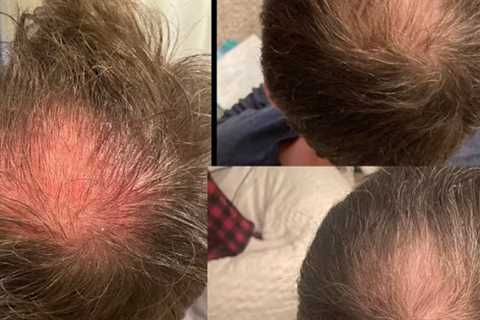 Hair Growth Injections Havertown, PA · Monday, Apr 28 📸